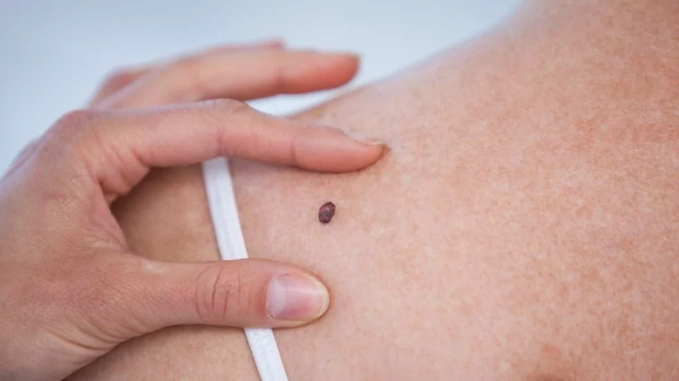 Avanza la cura contra el cáncer de piel: la Anmat aprobó una vacuna