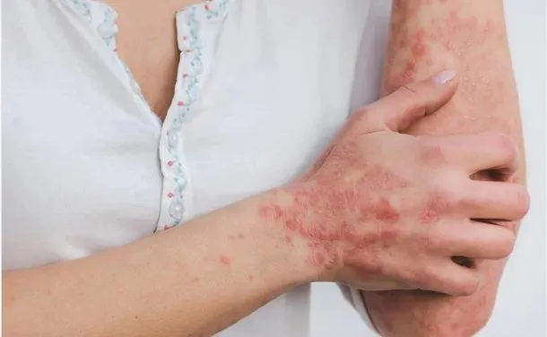 Viruela del mono: ya hay más de 50 mil casos en todo el mundo