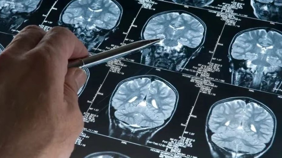 Estados Unidos aprobó un fármaco que retrasa moderadamente el Alzheimer