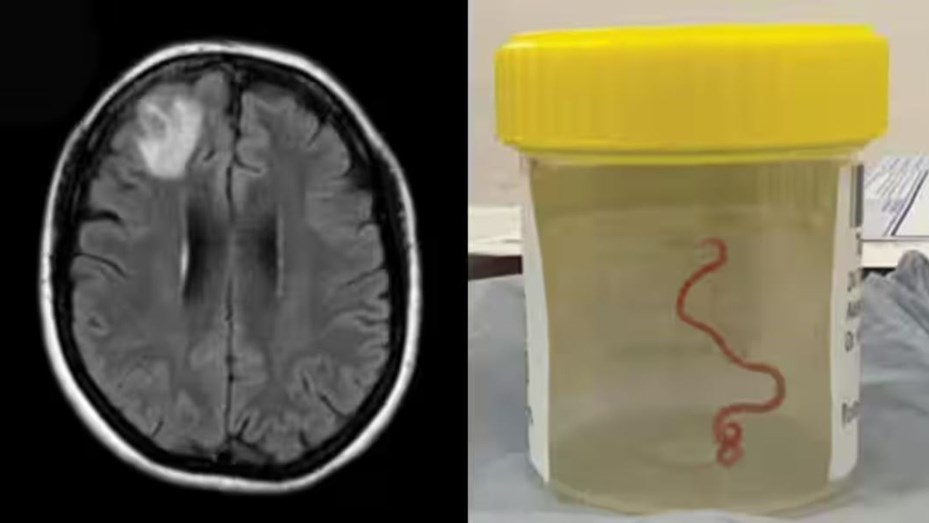 Extrajeron una lombriz de 8 centímetros del cerebro de una mujer en Australia