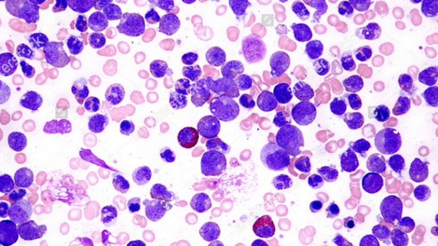 Se diagnostican más de mil casos de leucemia linfocítica crónica por año en la Argentina