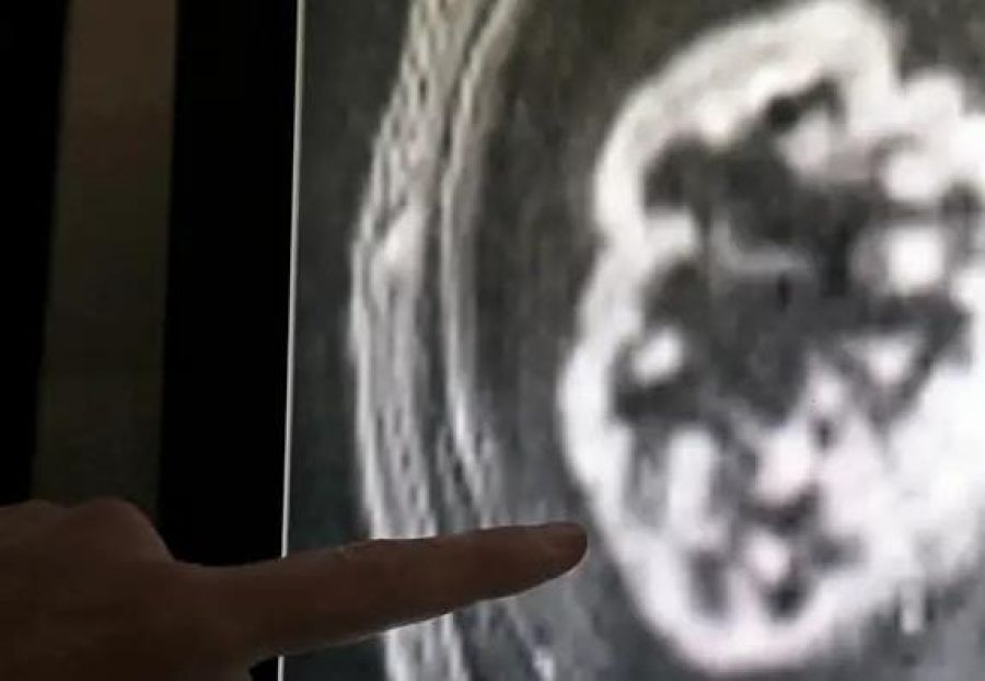 Elevado índice de sobrediagnóstico de cáncer de mama entre mujeres mayores